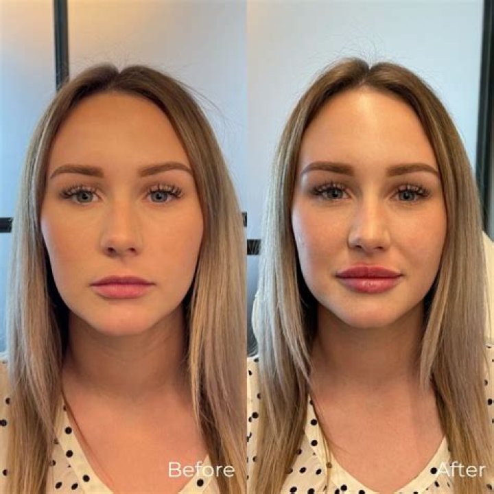 Aryna Sabalenka | Plastic Surgery Before And After