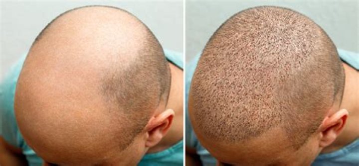 
Devout Muslim Luke Shaw Hair Transplant And Tattoos 
