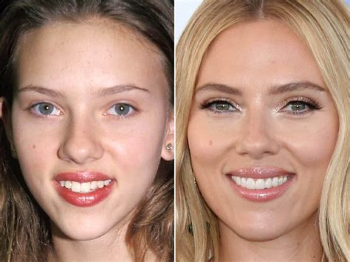 
Has Scarlett Johansson Had Plastic Surgery? Truth Revealed Here 
